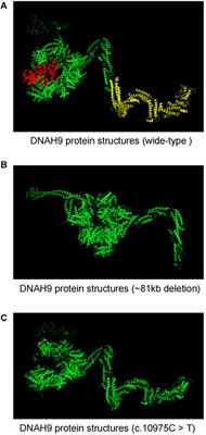 Fetal Congenital Heart Disease Caused by Compound Heterozygous Mutations in the DNAH9 Gene: A Case Report